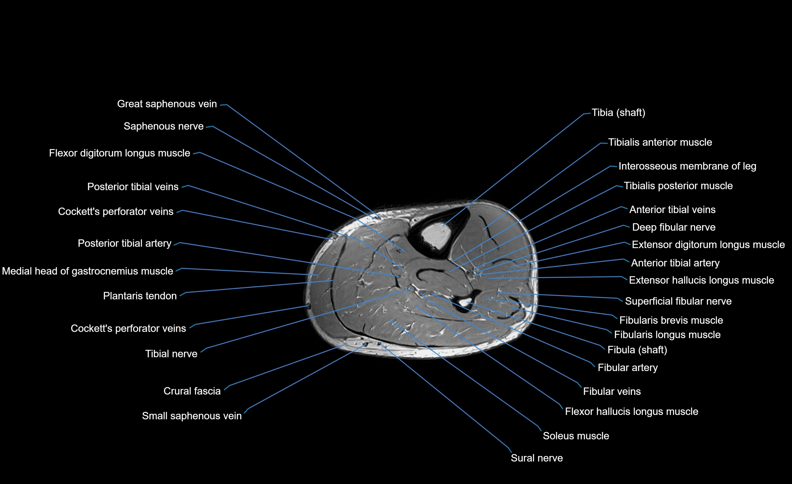 MRI lower leg axial cross sectional anatomy 3T  radiology  image-img-00001-00052.webp